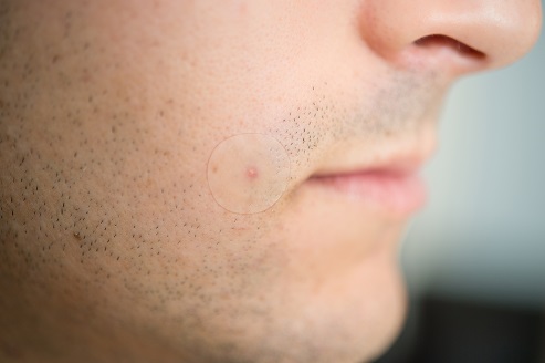 Acne Dots