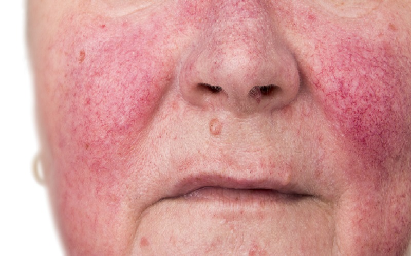 Rosacea_Blog