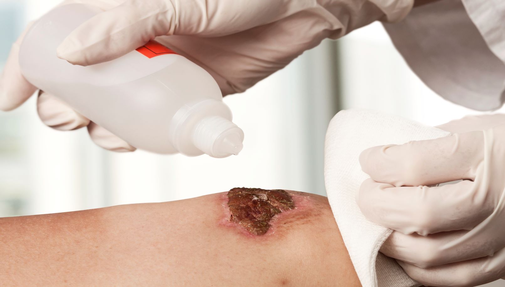 Wound Cleansers iStock-518260687 Wound Cleansers iStock-518260687