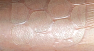 HHH - Hydrocolloid Hydrogel Hybrid